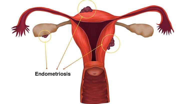 Diagnosis of Endometriosis