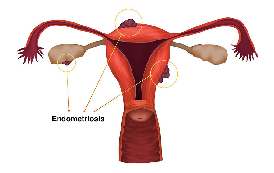 Diagnosis of Endometriosis