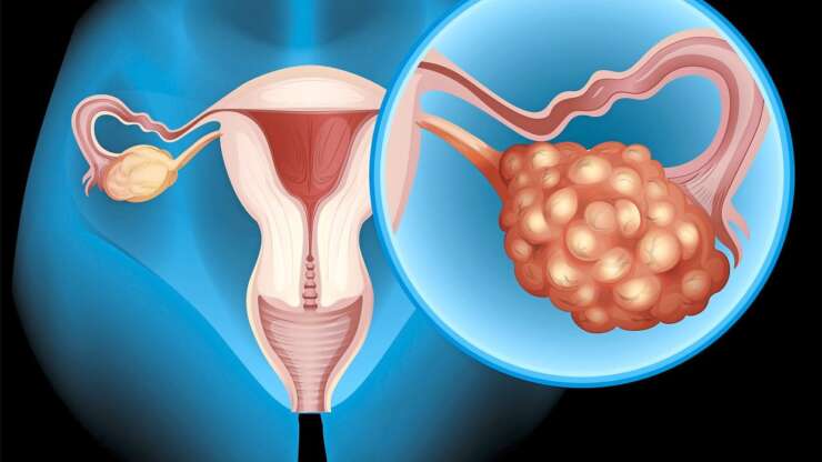 Endometriosis and ovarian cancer