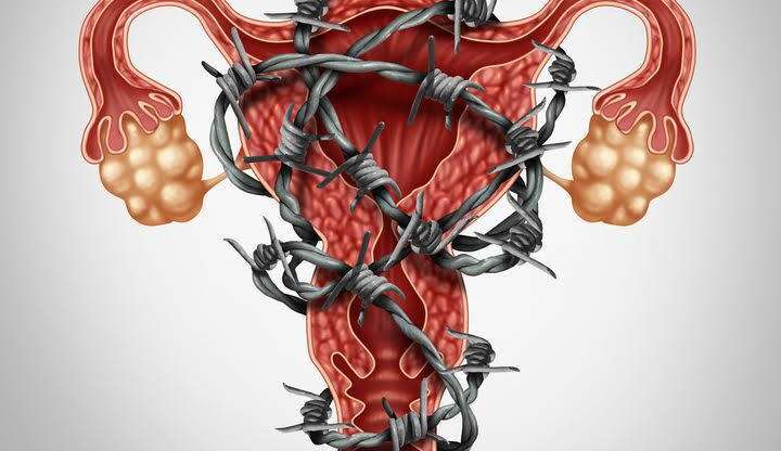 The 3 types of Endometriosis