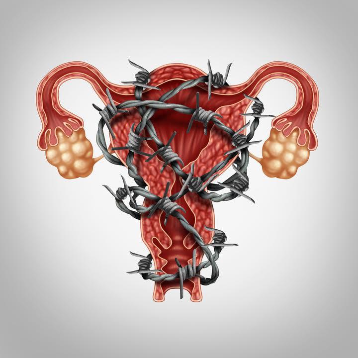 The 3 types of Endometriosis