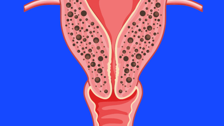 Adenomyosis: An Enigmatic Disease