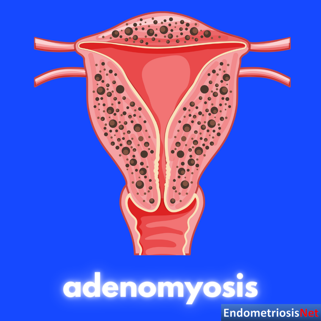 Adenomyosis: An Enigmatic Disease