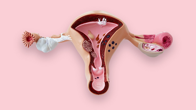 Recurrent Endometrioma: A Marker of Disease Severity?